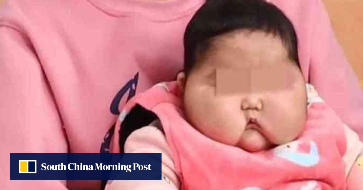 Steroid cream gives Chinese baby hairy cheeks and causes her weight to  shoot up; angry dad demands answers from producer | South China Morning Post